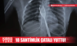 Doktorlar inanamadı, röntgende ortaya çıktı: 18 santimlik çatal ameliyatla çıkarıldı!