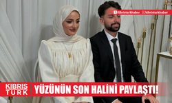 Amin Reis Gizem Yıldız'ın yüzü yandı! Son halini sosyal medyadan paylaştı