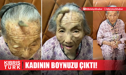 Çin'de bir garip olay! 107 yaşındaki kadının boynuzu çıktı