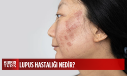 Lupus hastalığı hakkında bilmeniz gerekenler