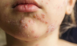 Bangladeş'te kızamık salgını: 712 çocuk hayatını kaybetti