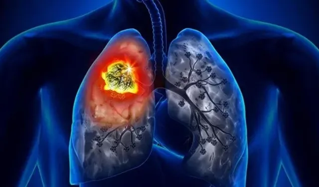 Akciğer kanserinde devrim yaratacak yeni tedavi yöntemi