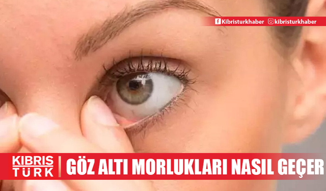 Göz altı morlukları nedir, neden olur ve nasıl geçer? Geçmeyen göz altı morluklarına ne iyi gelir?