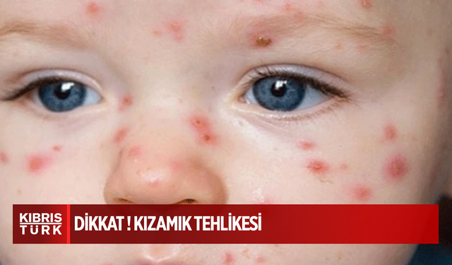 ABD'de kızamık salgını 12 eyalete yayıldı