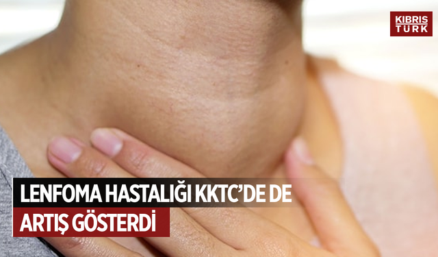 Özkayalar: Lenfoma hastalığı KKTC’de de artış gösterdi