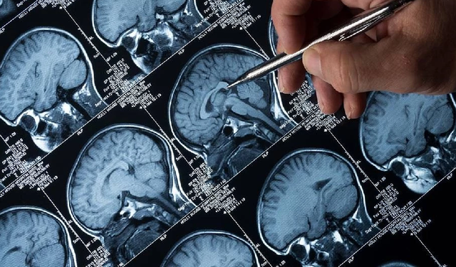 Zayıflama iğnelerinin Alzheimer'ın ilerlemesini yavaşlattığı bulundu