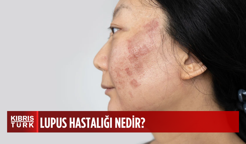 Lupus hastalığı hakkında bilmeniz gerekenler